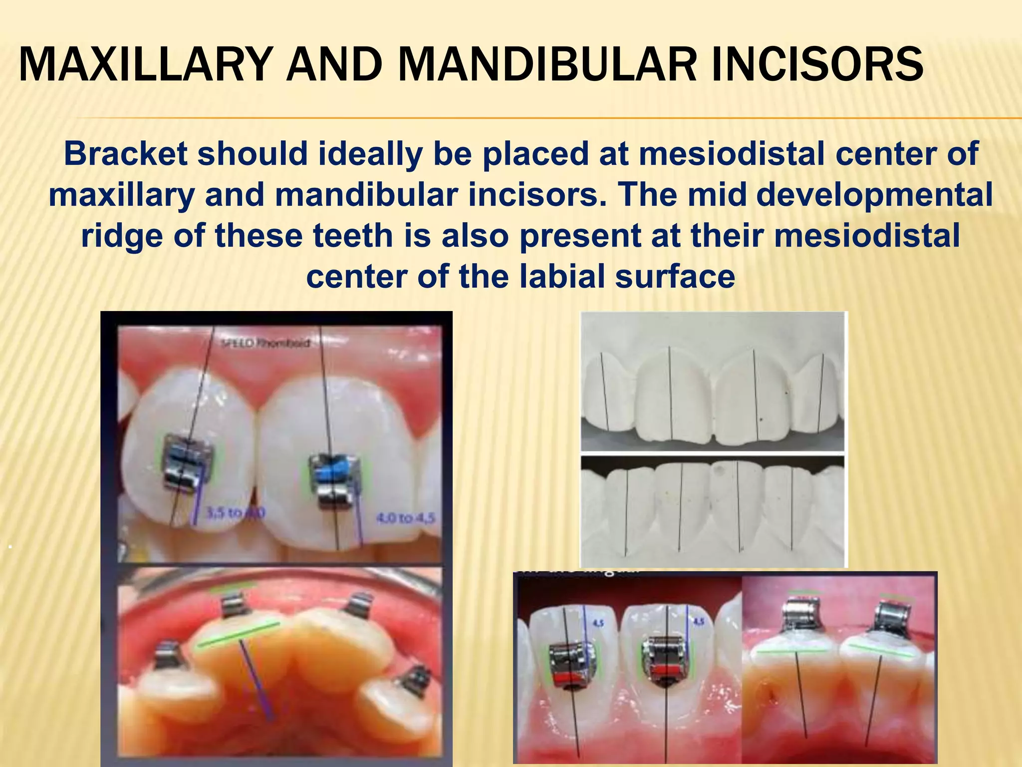 BRACKET PLACEMENT IN ORTHODONTIC BONDING | PPTX