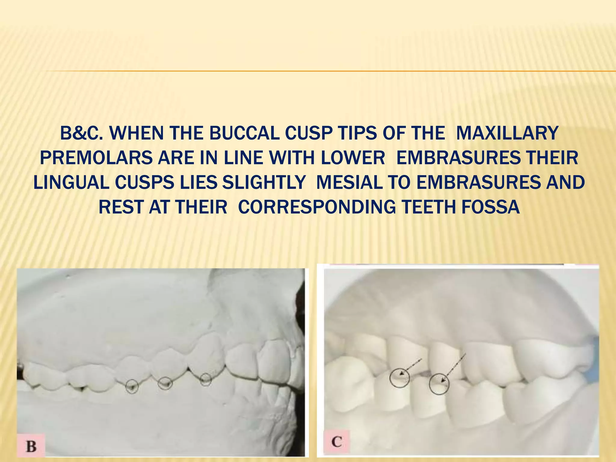 BRACKET PLACEMENT IN ORTHODONTIC BONDING | PPTX