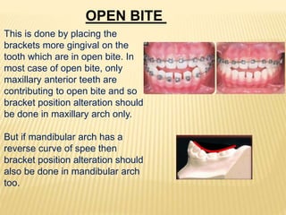 OPEN BITE
This is done by placing the
brackets more gingival on the
tooth which are in open bite. In
most case of open bite, only
maxillary anterior teeth are
contributing to open bite and so
bracket position alteration should
be done in maxillary arch only.
But if mandibular arch has a
reverse curve of spee then
bracket position alteration should
also be done in mandibular arch
too.
 