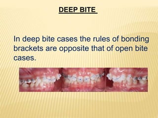 DEEP BITE
In deep bite cases the rules of bonding
brackets are opposite that of open bite
cases.
 