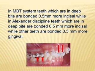 In MBT system teeth which are in deep
bite are bonded 0.5mm more incisal while
in Alexander discipline teeth which are in
deep bite are bonded 0.5 mm more incisal
while other teeth are bonded 0.5 mm more
gingival.
 