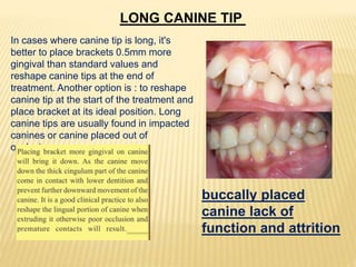 LONG CANINE TIP
In cases where canine tip is long, it's
better to place brackets 0.5mm more
gingival than standard values and
reshape canine tips at the end of
treatment. Another option is : to reshape
canine tip at the start of the treatment and
place bracket at its ideal position. Long
canine tips are usually found in impacted
canines or canine placed out of
occlusion.
buccally placed
canine lack of
function and attrition
 