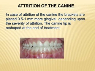 ATTRITION OF THE CANINE.
In case of attrition of the canine the brackets are
placed 0.5-1 mm more gingival, depending upon
the severity of attrition. The canine tip is
reshaped at the end of treatment.
 