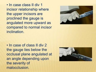 • In case class II div 1
incisor relationship where
the upper incisors are
proclined the gauge is
angulated more upward as
compared to normal incisor
inclination.
• In case of class II div 2
the gauge lies below the
occlusal plane angulated at
an angle depending upon
the severity of
malocclusion.
 