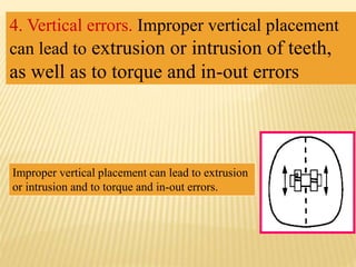 4. Vertical errors. Improper vertical placement
can lead to extrusion or intrusion of teeth,
as well as to torque and in-out errors
Improper vertical placement can lead to extrusion
or intrusion and to torque and in-out errors.
 