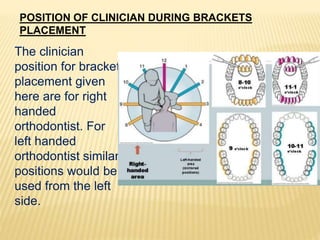 POSITION OF CLINICIAN DURING BRACKETS
PLACEMENT
The clinician
position for bracket
placement given
here are for right
handed
orthodontist. For
left handed
orthodontist similar
positions would be
used from the left
side.
 