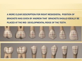 A MORE CLEAR DESCRIPTION FOR RIGHT MESIODISTAL POSITION OF
BRACKETS WAS GIVEN BY ANDREW THAT BRACKETS SHOULD IDEALLY BE
PLACED AT THE MID DEVELOPMENTAL RIDGE OF THE TEETH.
 