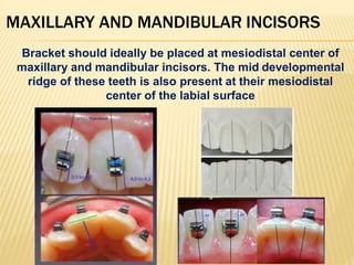 MAXILLARY AND MANDIBULAR INCISORS
Bracket should ideally be placed at mesiodistal center of
maxillary and mandibular incisors. The mid developmental
ridge of these teeth is also present at their mesiodistal
center of the labial surface
.
 