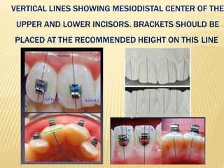 VERTICAL LINES SHOWING MESIODISTAL CENTER OF THE
UPPER AND LOWER INCISORS. BRACKETS SHOULD BE
PLACED AT THE RECOMMENDED HEIGHT ON THIS LINE.
 