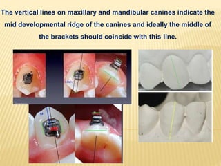 {
The vertical lines on maxillary and mandibular canines indicate the
mid developmental ridge of the canines and ideally the middle of
the brackets should coincide with this line.
 
