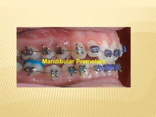 Mandibular Premolars
 