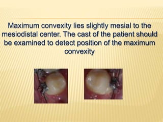 Maximum convexity lies slightly mesial to the
mesiodistal center. The cast of the patient should
be examined to detect position of the maximum
convexity
 