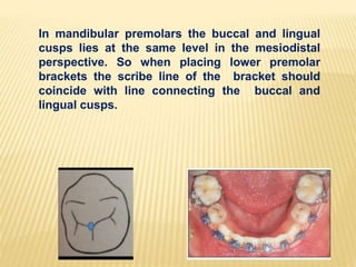 In mandibular premolars the buccal and lingual
cusps lies at the same level in the mesiodistal
perspective. So when placing lower premolar
brackets the scribe line of the bracket should
coincide with line connecting the buccal and
lingual cusps.
 