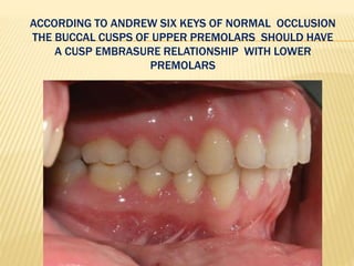 ACCORDING TO ANDREW SIX KEYS OF NORMAL OCCLUSION
THE BUCCAL CUSPS OF UPPER PREMOLARS SHOULD HAVE
A CUSP EMBRASURE RELATIONSHIP WITH LOWER
PREMOLARS
 
