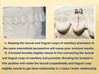 A. Keeping the buccal and lingual cusps of maxillary premolars in
the same mesiodistal perspective will cause poor occlusal results..
D. A bracket bonded slightly mesial to line connecting the buccal
and lingual cusp of maxillary 2nd premolar. Bonding the bracket in
this position will rotate the buccal cuspsdistally and lingual cusp
slightly mesial to get ideal relationship in a class I molar relationship
 