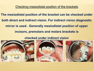 Checking mesiodistal position of the brackets
The mesiodistal position of the bracket can be checked under
both direct and indirect vision. For indirect vision diagnostic
mirror is used . Generally mesiodistal position of upper
incisors, premolars and molars brackets is
checked under indirect vision
 