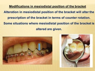 Modifications in mesiodistal position of the bracket
Alteration in mesiodistal position of the bracket will alter the
prescription of the bracket in terms of counter rotation.
Some situations where mesiodistal position of the bracket is
altered are given.
 