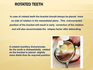 ROTATED TEETH
In case of rotated teeth the bracket should always be placed more
on side of rotation in the mesiodistal plane . This overcorrected
position of the bracket will result in early correction of the rotation
and will also accommodate the relapse factor after debonding.
A rotated maxillary 2nd premolar,
As the tooth is distopalatally rotated
so the bracket is placed slightly
more distal than its required position
 