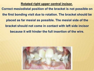 Rotated right upper central incisor.
Correct mesiodistal position of the bracket is not possible on
the first bonding visit due to rotation. The bracket should be
placed as far mesial as possible. The mesial side of the
bracket should not come in contact with left side incisor
because it will hinder the full insertion of the wire.
 