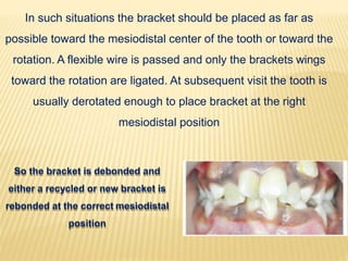 In such situations the bracket should be placed as far as
possible toward the mesiodistal center of the tooth or toward the
rotation. A flexible wire is passed and only the brackets wings
toward the rotation are ligated. At subsequent visit the tooth is
usually derotated enough to place bracket at the right
mesiodistal position
So the bracket is debonded and
either a recycled or new bracket is
rebonded at the correct mesiodistal
position
 