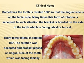 Clinical Notes
Sometimes the tooth is rotated 180° so that the lingual side is
on the facial side. Many times this form of rotation is
accepted. In such situation the bracket is bonded on the side
of the tooth which is facing labial or buccal .
Right lower lateral is rotated
180°.The rotation was
accepted and bracket placed
on lingual side of the tooth
which was facing labially
 