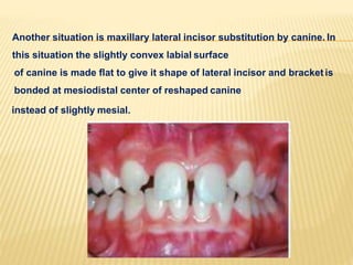 Another situation is maxillary lateral incisor substitution by canine. In
this situation the slightly convex labial surface
of canine is made flat to give it shape of lateral incisor and bracket is
bonded at mesiodistal center of reshaped canine
instead of slightly mesial.
 