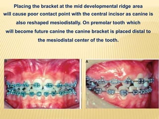 Placing the bracket at the mid developmental ridge area
will cause poor contact point with the central incisor as canine is
also reshaped mesiodistally. On premolar tooth which
will become future canine the canine bracket is placed distal to
the mesiodistal center of the tooth.
 
