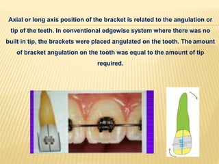 Axial or long axis position of the bracket is related to the angulation or
tip of the teeth. In conventional edgewise system where there was no
built in tip, the brackets were placed angulated on the tooth. The amount
of bracket angulation on the tooth was equal to the amount of tip
required.
 