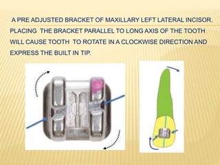 A PRE ADJUSTED BRACKET OF MAXILLARY LEFT LATERAL INCISOR.
PLACING THE BRACKET PARALLEL TO LONG AXIS OF THE TOOTH
WILL CAUSE TOOTH TO ROTATE IN A CLOCKWISE DIRECTION AND
EXPRESS THE BUILT IN TIP.
 