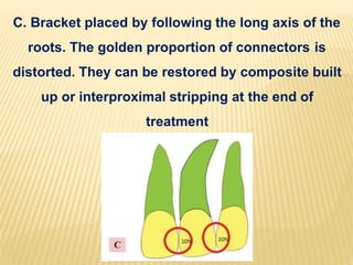 C. Bracket placed by following the long axis of the
roots. The golden proportion of connectors is
distorted. They can be restored by composite built
up or interproximal stripping at the end of
treatment
 