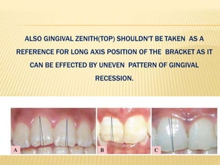 ALSO GINGIVAL ZENITH(TOP) SHOULDN'T BE TAKEN AS A
REFERENCE FOR LONG AXIS POSITION OF THE BRACKET AS IT
CAN BE EFFECTED BY UNEVEN PATTERN OF GINGIVAL
RECESSION.
 