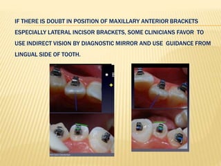 IF THERE IS DOUBT IN POSITION OF MAXILLARY ANTERIOR BRACKETS
ESPECIALLY LATERAL INCISOR BRACKETS, SOME CLINICIANS FAVOR TO
USE INDIRECT VISION BY DIAGNOSTIC MIRROR AND USE GUIDANCE FROM
LINGUAL SIDE OF TOOTH.
 