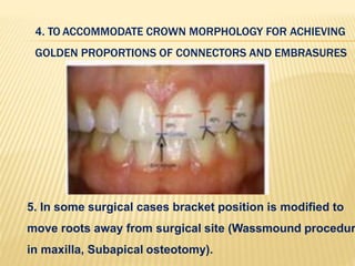 5. In some surgical cases bracket position is modified to
move roots away from surgical site (Wassmound procedur
in maxilla, Subapical osteotomy).
4. TO ACCOMMODATE CROWN MORPHOLOGY FOR ACHIEVING
GOLDEN PROPORTIONS OF CONNECTORS AND EMBRASURES
 