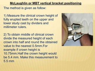 McLaughlin or MBT vertical bracket positioning
The method is given as follow:
1) Measure the clinical crown height of
fully erupted teeth on the upper and
lower study cast by dividers and
millimeter rulers.
2) To obtain middle of clinical crown
divide the measured height of each
crown into half and round the obtained
value to the nearest 0.5mm.For
example if crown height is
10.75mm.Half the crown height would
be 5.4 mm. Make this measurement to
5.5 mm
 