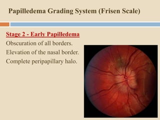 5. papilloedema | PPTX