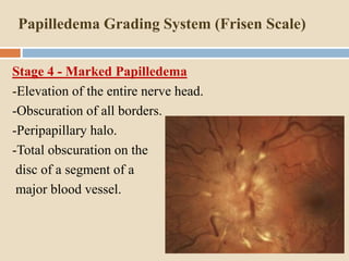 5. papilloedema | PPTX