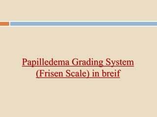 Papilledema Grading System
(Frisen Scale) in breif
 