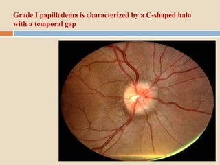 Grade I papilledema is characterized by a C-shaped halo
with a temporal gap
 