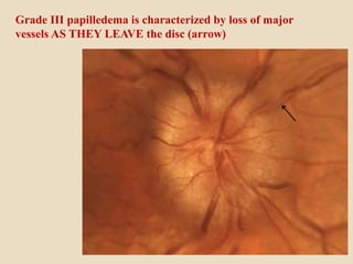 Grade III papilledema is characterized by loss of major
vessels AS THEY LEAVE the disc (arrow)
 