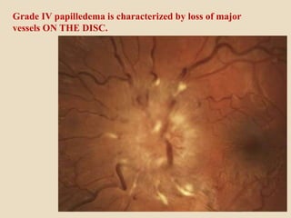 Grade IV papilledema is characterized by loss of major
vessels ON THE DISC.
 