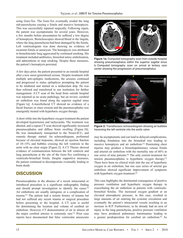 Worsening Tension Pneumocephalus from Late Posttraumatic Ventriculo