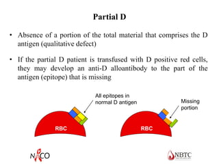 Partial D
• Absence of a portion of the total material that comprises the D
antigen (qualitative defect)
• If the partial D patient is transfused with D positive red cells,
they may develop an anti-D alloantibody to the part of the
antigen (epitope) that is missing
Missing
portion
RBC RBC
All epitopes in
normal D antigen
 