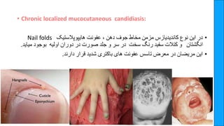 • Chronic localized mucocutaneous candidiasis:
•
‫در‬
‫این‬
‫نوع‬
‫کاندیدیازس‬
‫مزمن‬
‫مخاط‬
‫جوف‬
‫دهن‬
،
‫عفونت‬
‫هایپوپالستیک‬
Nail folds
‫انگشتان‬
‫و‬
‫کتالت‬
‫سفید‬
‫رنگ‬
‫سخت‬
‫در‬
‫سر‬
‫و‬
‫جلد‬
‫صورت‬
‫در‬
‫دوران‬
‫اولیه‬
‫بوجود‬
‫م‬
‫یاید‬
.
•
‫این‬
‫مریضان‬
‫در‬
‫معرض‬
‫تاسس‬
‫عفونت‬
‫های‬
‫باکتری‬
‫شدید‬
‫قرار‬
‫دارند‬
.
 