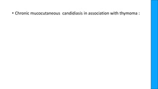 • Chronic mucocutaneous candidiasis in association with thymoma :
 
