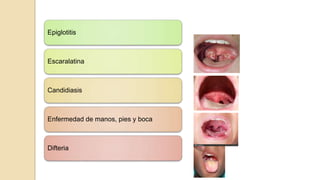 Epiglotitis
Escaralatina
Candidiasis
Enfermedad de manos, pies y boca
Difteria
 