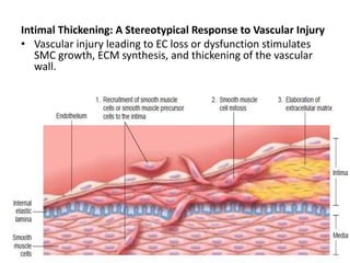 Intimal Thickening: A Stereotypical Response to Vascular Injury
• Vascular injury leading to EC loss or dysfunction stimulates
SMC growth, ECM synthesis, and thickening of the vascular
wall.
 