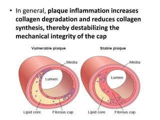 • In general, plaque inflammation increases
collagen degradation and reduces collagen
synthesis, thereby destabilizing the
mechanical integrity of the cap
 