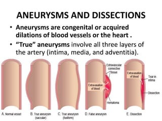 ANEURYSMS AND DISSECTIONS
• Aneurysms are congenital or acquired
dilations of blood vessels or the heart .
• “True” aneurysms involve all three layers of
the artery (intima, media, and adventitia).
 
