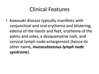 Clinical Features
• Kawasaki disease typically manifests with
conjunctival and oral erythema and blistering,
edema of the hands and feet, erythema of the
palms and soles, a desquamative rash, and
cervical lymph node enlargement (hence its
other name, mucocutaneous lymph node
syndrome).
 