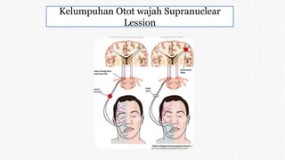 Kelumpuhan Otot wajah Supranuclear
Lession
 